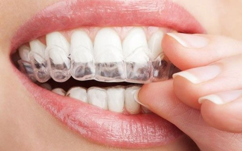 Niềng răng trong suốt Invisalign - công nghệ chỉnh nha hiện đại nhất hiện nay