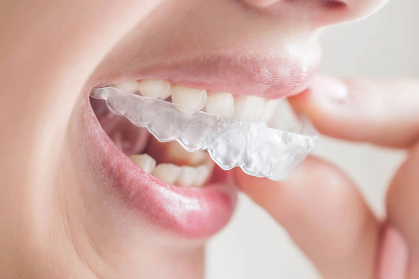 Niềng răng trong suốt 3D Clear được nhiều khách hàng đánh giá cao